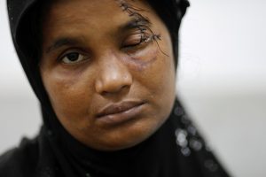FILE PHOTO: Gultaz Begum, who said she fled from Myanmar with her seven children after she was shot in the eye, her husband killed and village burnt, rests at the ward for Rohingya refugees in Sadar hospital in Cox's Bazar, Bangladesh September 28, 2017. REUTERS/Damir Sagolj/File Photo