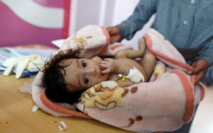 A child looks on as a relative wraps it with a blanket at the malnutrition ward of al-Sabeen hospital in Sanaa, Yemen September 11, 2018. REUTERS/Khaled Abdullah