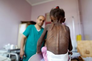 FILE PHOTO: A nurse looks as he weighs a malnourished girl at a malnutrition treatment center in Sanaa, Yemen October 7, 2018. Picture taken October 7, 2018. REUTERS/Khaled Abdullah - RC17C03A5010/File Photo