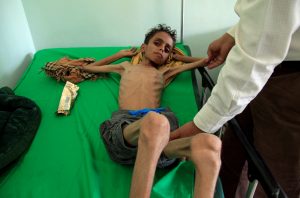 A doctor checks malnourished Ghazi Ahmad, 10, at a hospital in Taiz, Yemen October 30, 2018. Picture taken October 30, 2018. REUTERS/Anees Mahyoub